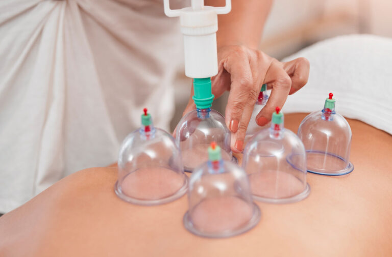Piston Air Sucking Cups: Cupping Without the Flame